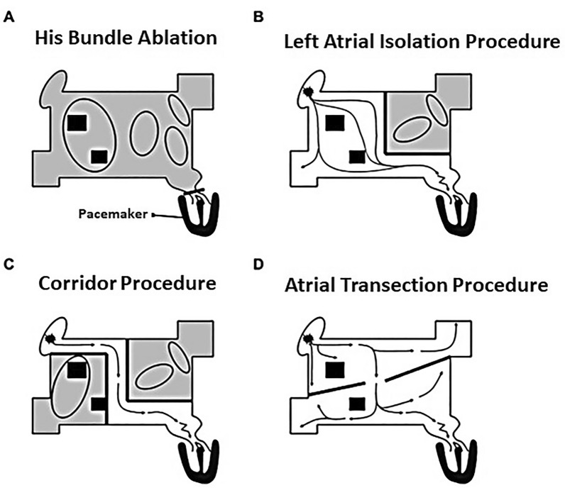 Narrative Review: Surgical and Hybrid Management of Atrial Fibrillation.