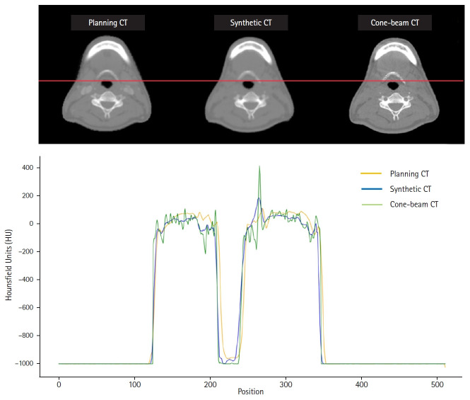 Supervised deep learning-based synthetic computed tomography from kilovoltage cone-beam computed tomography images for adaptive radiation therapy in head and neck cancer.