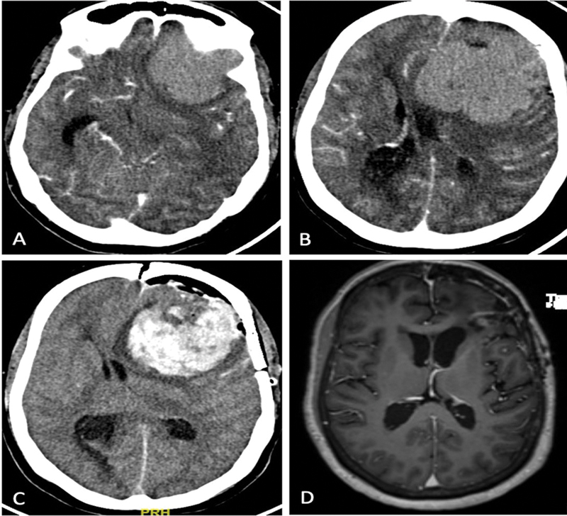 Emergency Surgical Management of Meningiomas: Factors Affecting Early Outcomes and Complications.