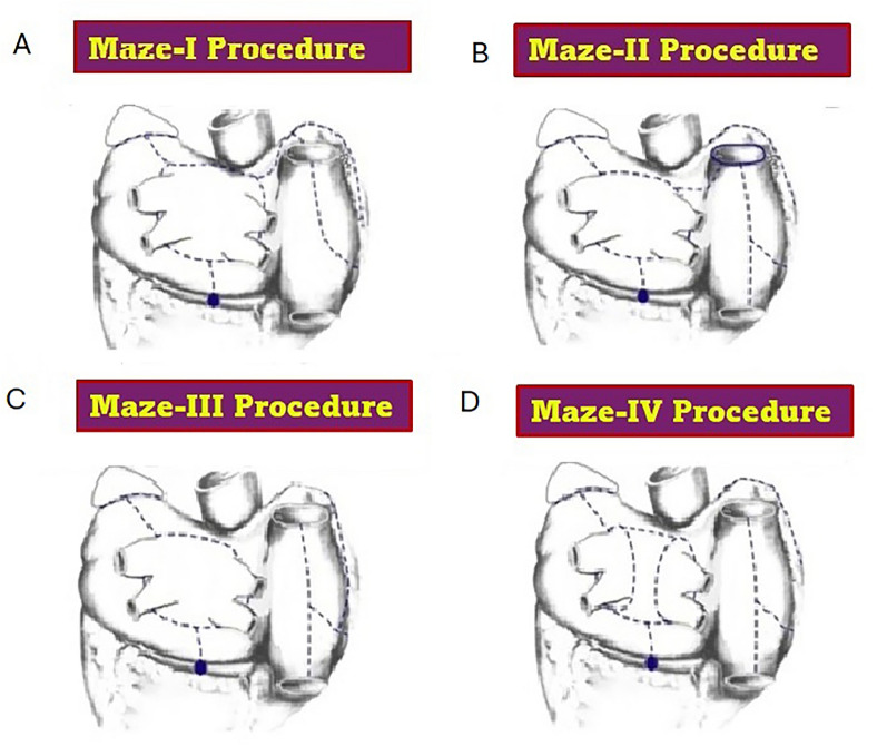 Narrative Review: Surgical and Hybrid Management of Atrial Fibrillation.