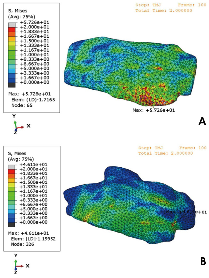 Finite element analysis of stabilization splint pressure distribution in a patient with disc displacement without reduction: A preliminary study.