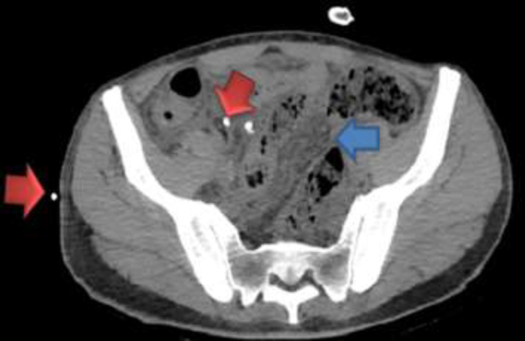 Concurrent peritoneal and pleural tuberculosis in an adult: A case report and literature review.