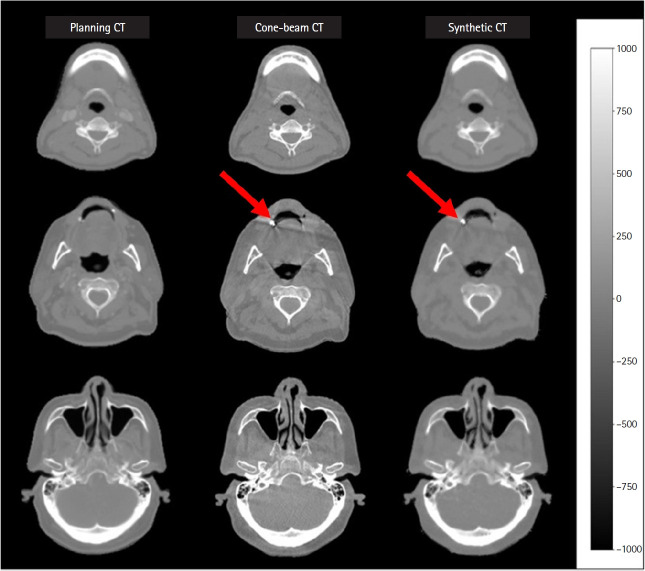 Supervised deep learning-based synthetic computed tomography from kilovoltage cone-beam computed tomography images for adaptive radiation therapy in head and neck cancer.