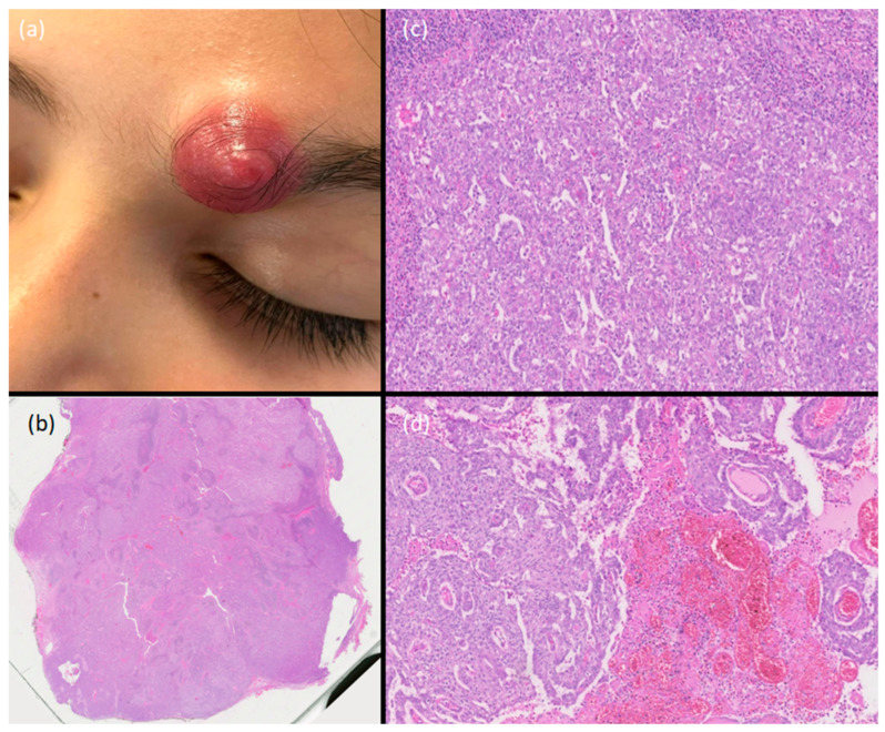 A Rapidly Growing Nodule on the Eyebrow of a Pediatric Patient.
