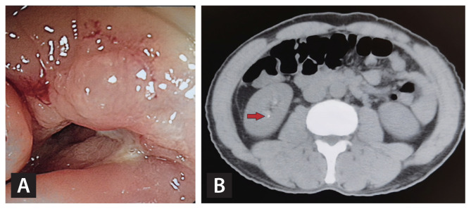 Prevalence and risk factors for gallstone and renal stone formation in patients with intestinal Behçet's disease.