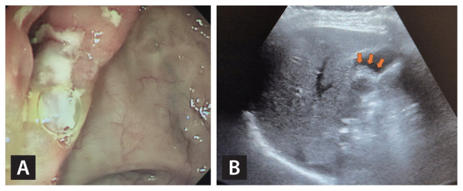 Prevalence and risk factors for gallstone and renal stone formation in patients with intestinal Behçet's disease.