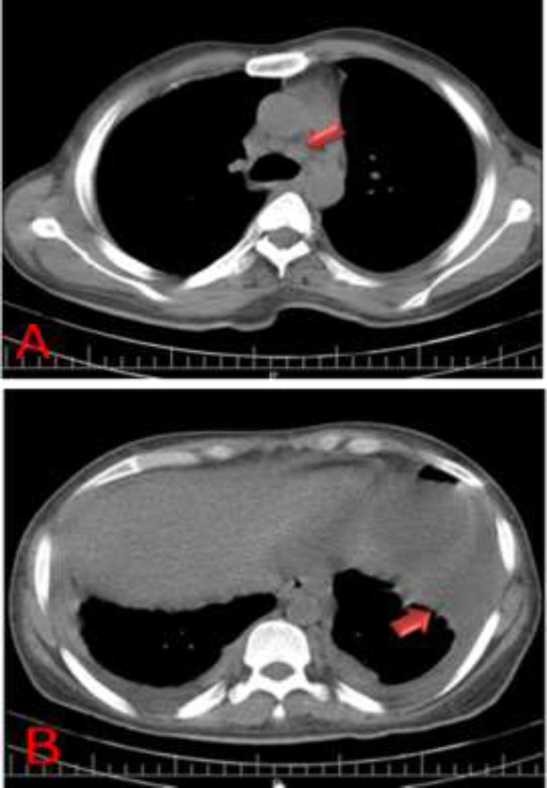 Concurrent peritoneal and pleural tuberculosis in an adult: A case report and literature review.