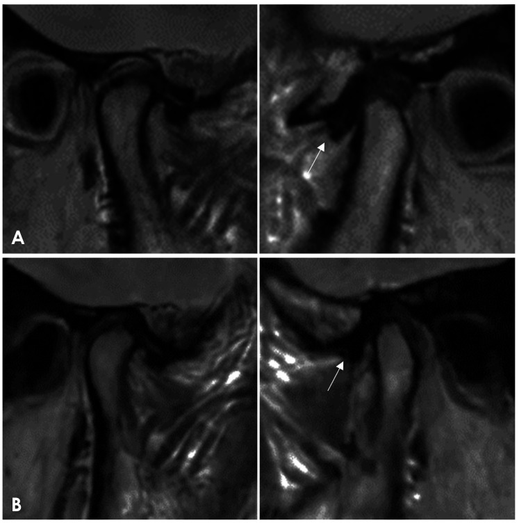 Finite element analysis of stabilization splint pressure distribution in a patient with disc displacement without reduction: A preliminary study.