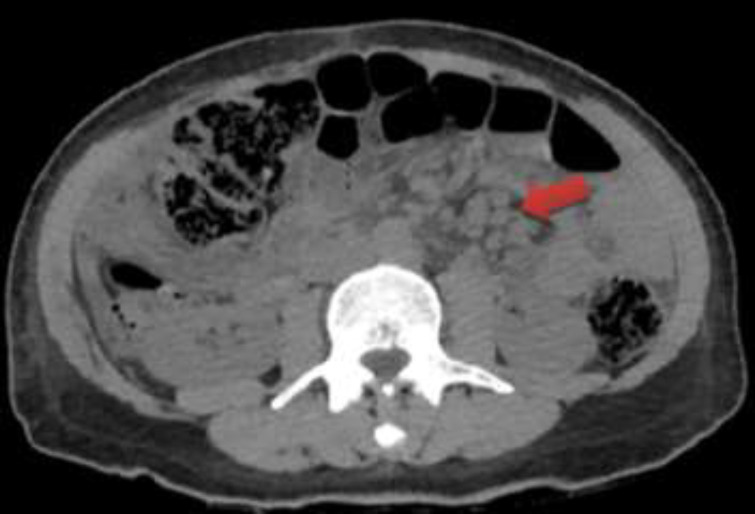 Concurrent peritoneal and pleural tuberculosis in an adult: A case report and literature review.