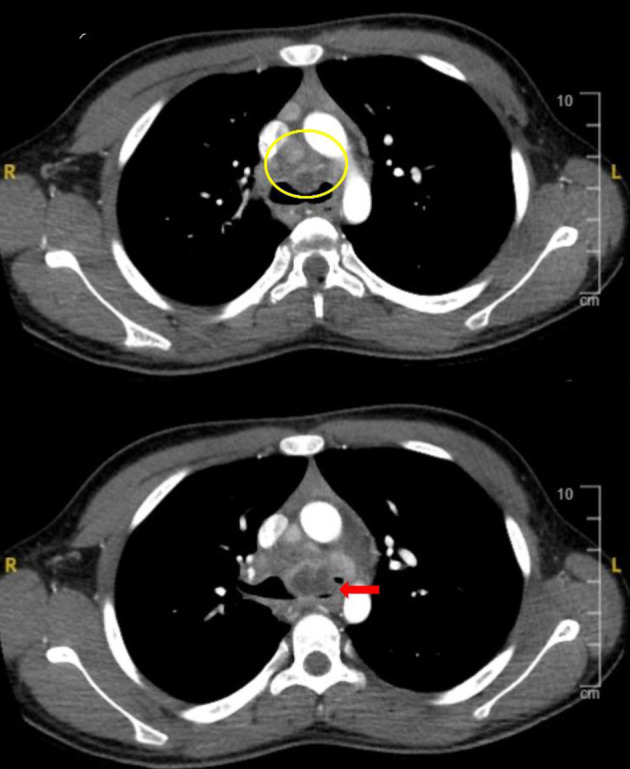 Respiratory Compromise Related to Primary Histoplasmosis Infection in Two Pediatric Patients.