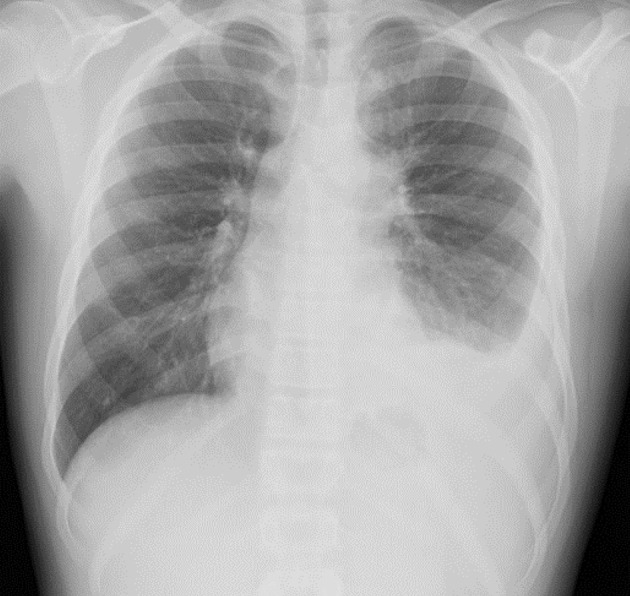Respiratory Compromise Related to Primary Histoplasmosis Infection in Two Pediatric Patients.