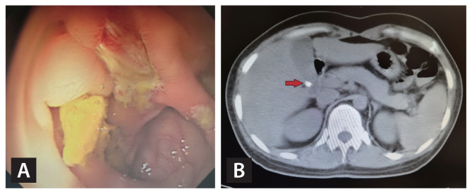 Prevalence and risk factors for gallstone and renal stone formation in patients with intestinal Behçet's disease.