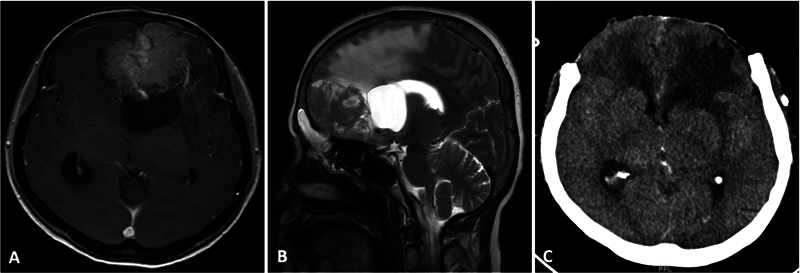 Emergency Surgical Management of Meningiomas: Factors Affecting Early Outcomes and Complications.