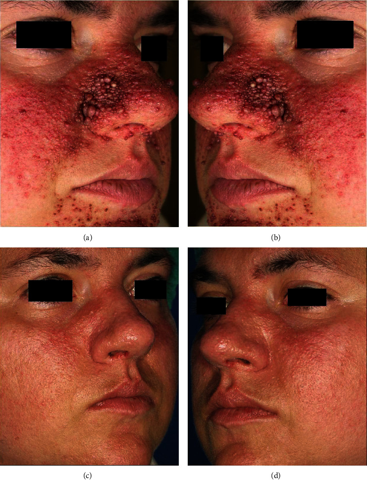 Effective Technique Using Combined CO<sub>2</sub> Laser and Pulsed Dye Laser for Facial Angiofibromas Management in Tuberous Sclerosis.