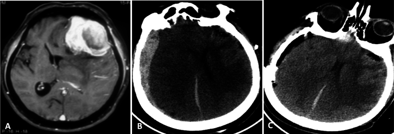 Emergency Surgical Management of Meningiomas: Factors Affecting Early Outcomes and Complications.