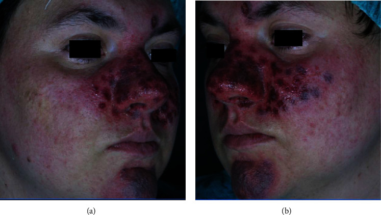 Effective Technique Using Combined CO<sub>2</sub> Laser and Pulsed Dye Laser for Facial Angiofibromas Management in Tuberous Sclerosis.
