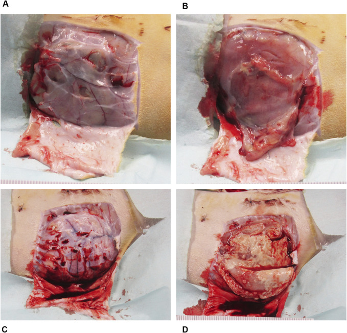 Preclinical evaluation of a novel antibiotic-eluting BioEnvelope for CIED infection prevention.