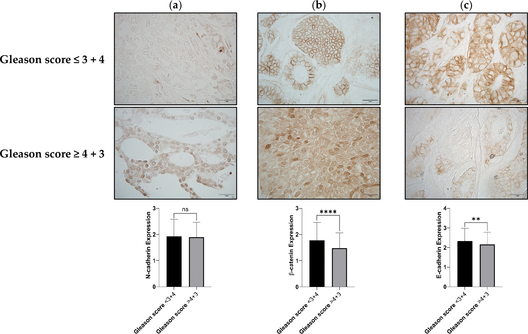 Integrating Proteomic Analysis and Machine Learning to Predict Prostate Cancer Aggressiveness.
