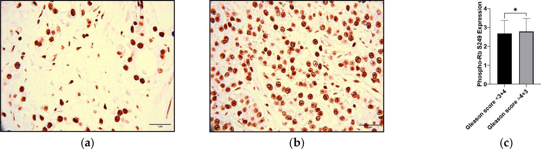 Integrating Proteomic Analysis and Machine Learning to Predict Prostate Cancer Aggressiveness.