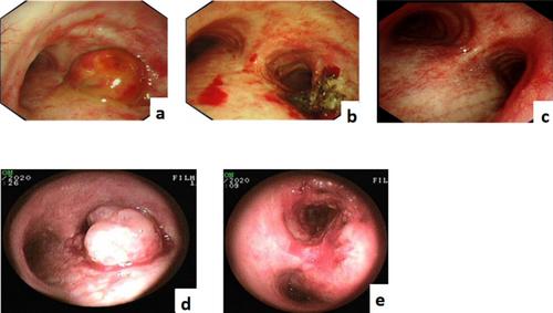 Bronchoscopic Interventional Therapy Combined With Pembrolizumab in the Treatment of Pulmonary Large Cell Neuroendocrine Carcinoma: A Case Report