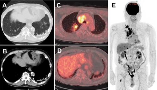 Atezolizumab-Induced Immune-Related Pneumonia on Rounded Atelectasis