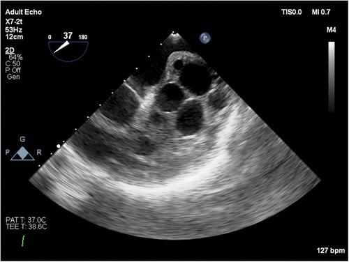 Pericardial hydatid cysts presenting with atrial flutter and mitral regurgitation