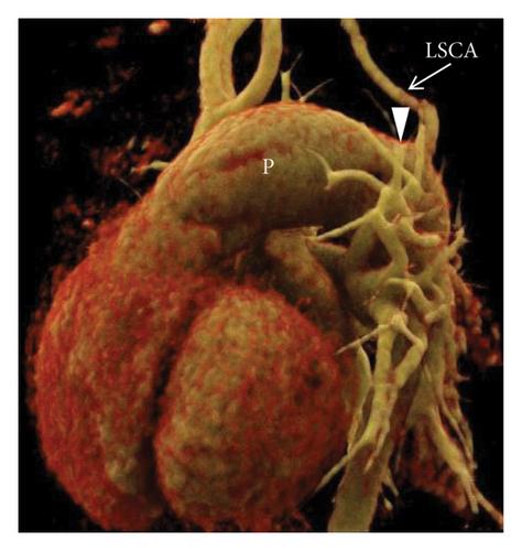 Interrupted Aortic Arch: Assessment of Morphology and Associated Cardiovascular Anomalies on Computed Tomography Angiography