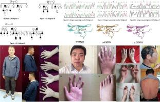 Missense variants of FBN2 associated with congenital arachnodactyly in three Chinese families