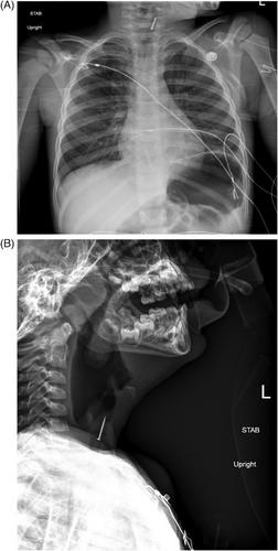 Unusual foreign body aspiration in a 4-year-old patient