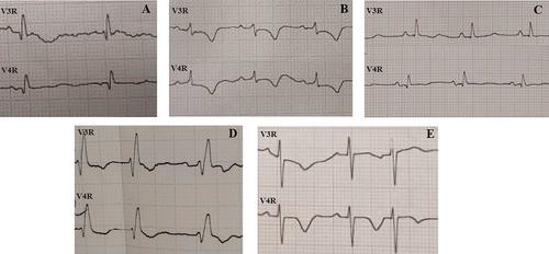 The Significance of Right-Sided Precordial ECG Leads (V3R and V4R) in Assessing Right Ventricular Dysfunction: A Single Center Cross-Sectional Study