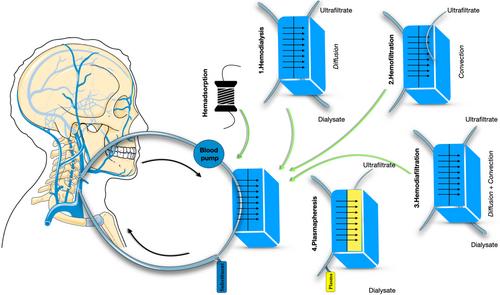 A hypothesis on treatment strategy of severe multicentric Castleman disease with continuous renal replacement therapy