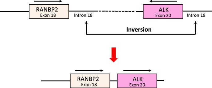 Complete morphologic response to gilteritinib in ALK-rearranged acute myeloid leukemia