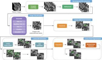 Automatic segmentation of deep endometriosis in the rectosigmoid using deep learning