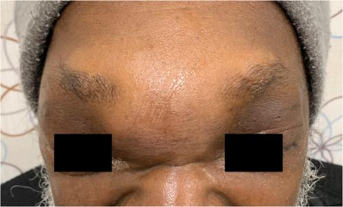 Man with forehead swelling