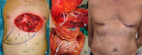 From Angiosomal to Bi-Angiosomal and Extra-Angiosomal Pedicled Perforator Flaps: Optimizing the Use of Local Tissues in Abdominal Wall Reconstruction