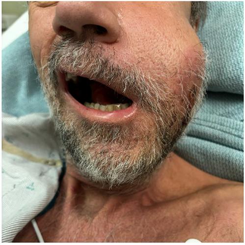 An adult male presenting with left buccal mass