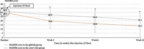 OnabotulinumtoxinA in Resistant Depression: A Randomized Trial Comparing Two Facial Injection Sites (OnaDEP Study)