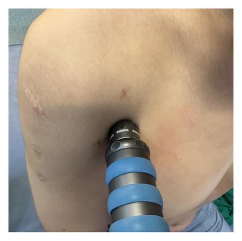 Extracorporeal Shockwave Therapy Reduces Pain and Improves Internal Rotation after Arthroscopic Capsular Release: A Randomized Clinical Trial