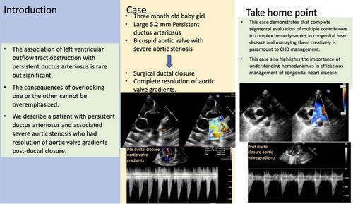 Resolution of high aortic valve systolic gradient suggesting significant stenosis following closure of patent ductus arteriosus