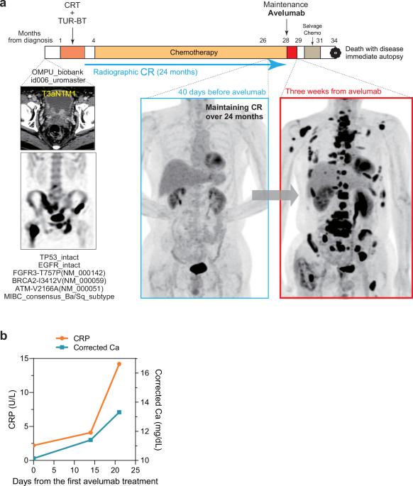 Mechanistic insights into lethal hyper progressive disease induced by PD-L1 inhibitor in metastatic urothelial carcinoma