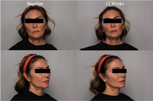 Real-World Clinical Experience With an Allograft Adipose Matrix for Replacing Volume Loss in Face, Hands, and Body