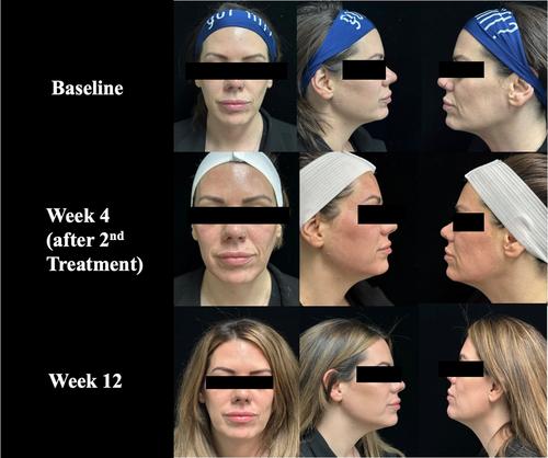 Real-World Experience Using a Multi-Modality System using Intense Pulsed Light, Radiofrequency Microneedling, High-Intensity Focused Ultrasound, or Thermal Radiofrequency, 808, HIFU for Skin Rejuvenation Treatment