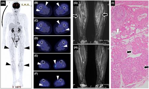 Muscular polyarteritis nodosa detected by FDG-PET/CT