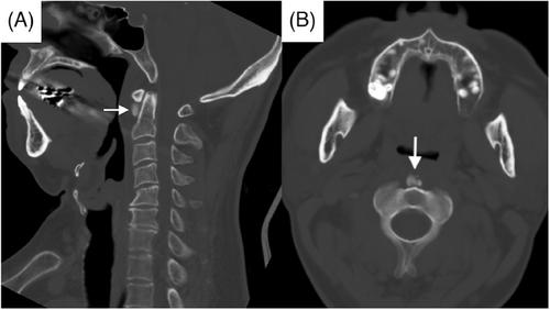 Man with severe neck pain