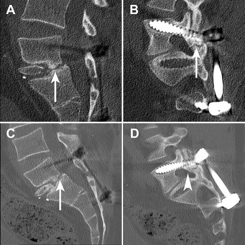 Free Vascularized Scapula tip Flap to L5—S1 Vertebral Defect After Chronic Infection Related to Interbody Fusion Cage: A Case Report