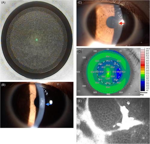 Corneal epithelial ingrowth after small incision lenticule extraction surgery: Insights from a case series and mechanistic studies