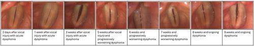 Revisiting the etiology and clinical characteristics of hemorrhagic polyps of the vocal fold