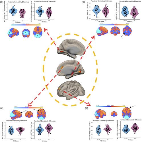 Physical activity and frontoparietal network connectivity in traumatic brain injury