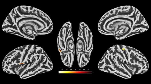 The association between adverse childhood experiences and alterations in brain volume and cortical thickness in adults with alcohol use disorder