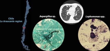 Pulmonary infection by Lophomonas spp. and Aspergillus spp. in a B-cell acute lymphocytic leukemia patient from Chile